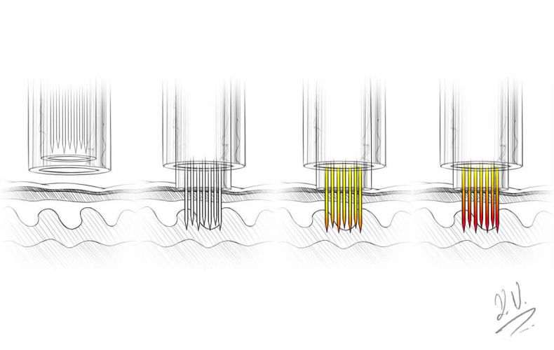 microneedling-radiofrequenz-in-zug