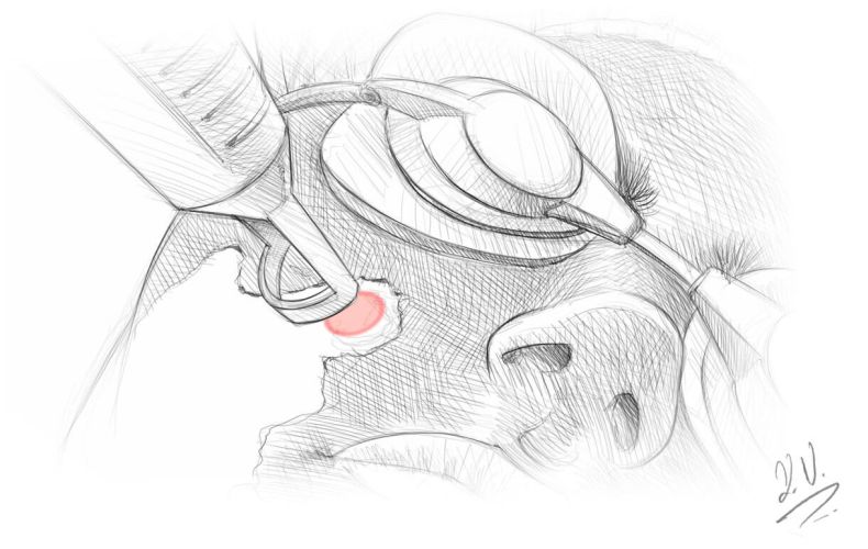 Carbon Laser Therapie
